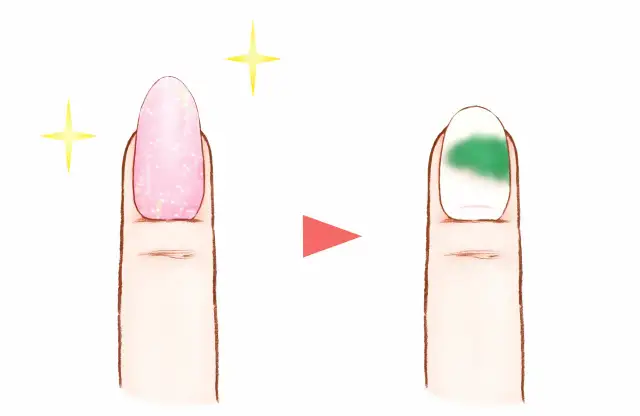 Zielona bakteria na paznokciu – czy jest zaraźliwa i jak się chronić?