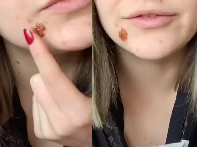 Zasuszyć pryszcza: apteka, dom i błędy, które szkodzą skórze