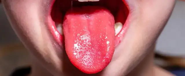 Zmiany na języku do jakiego lekarza udać się przy niepokojących objawach