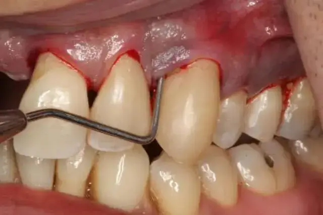 Skuteczne sposoby na bolące dziąsła w ciąży, które przynoszą ulgę