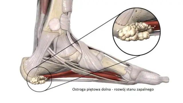 Ostroga piętowa: do jakiego lekarza i jak leczyć?