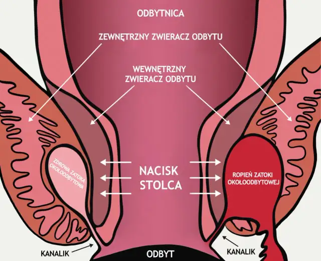 Zapchane gruczoły okołoodbytowe u psa objawy, które musisz znać
