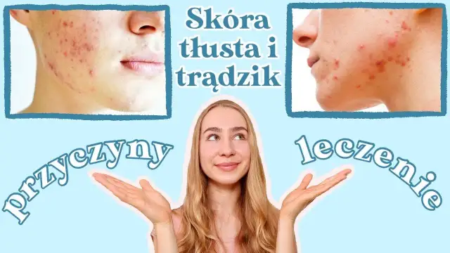 Jak skutecznie pozbyć się tłustej cery – sprawdzone metody i porady