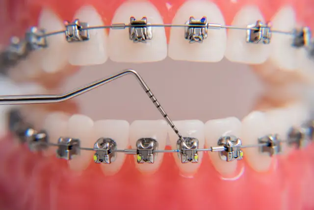 Ból po aparacie ortodontycznym: Jak sobie radzić i czy warto?
