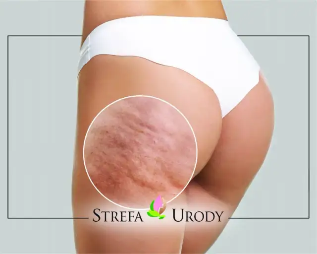 Gładkie uda bez cellulitu? Poznaj domowe i pro zabiegi!