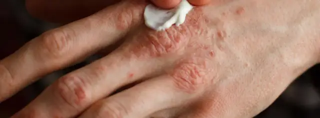 Skuteczne sposoby na liszaje bez recepty - ulga i zdrowie skóry