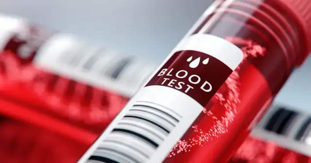 Troponina - co to za badanie i jak może uratować życie?