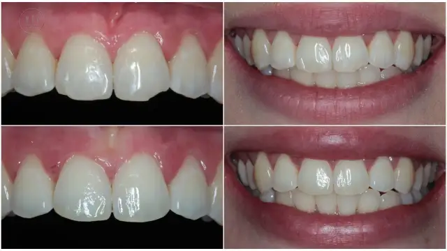 Ile licówek? Odkryj idealną liczbę dla Twojego uśmiechu!