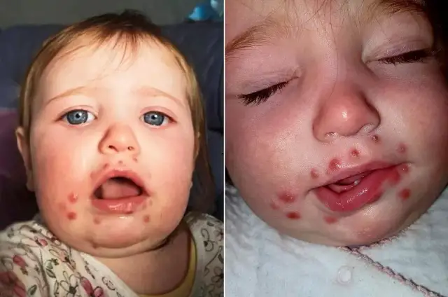 Opryszczka u przedszkolaka: Kiedy absolutnie NIE do placówki?