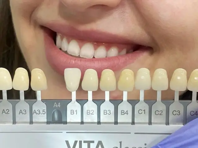 Uśmiech z idealnie białymi zębami, porównanie odcieni przed i po skalingu.