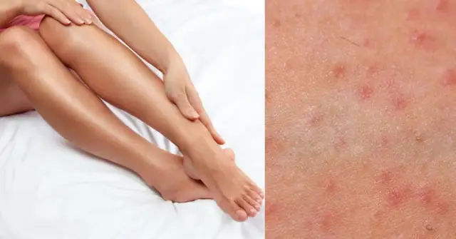 Krostki po goleniu? Pozbądź się ich! Gładka skóra bez podrażnień