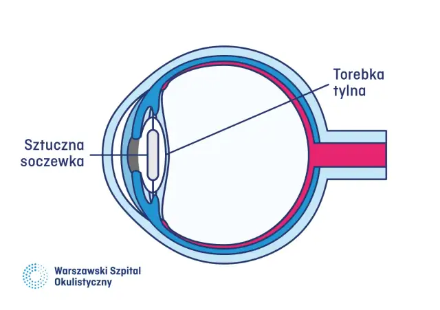 Zaćma: Kiedy operować drugie oko? Pełny komfort widzenia