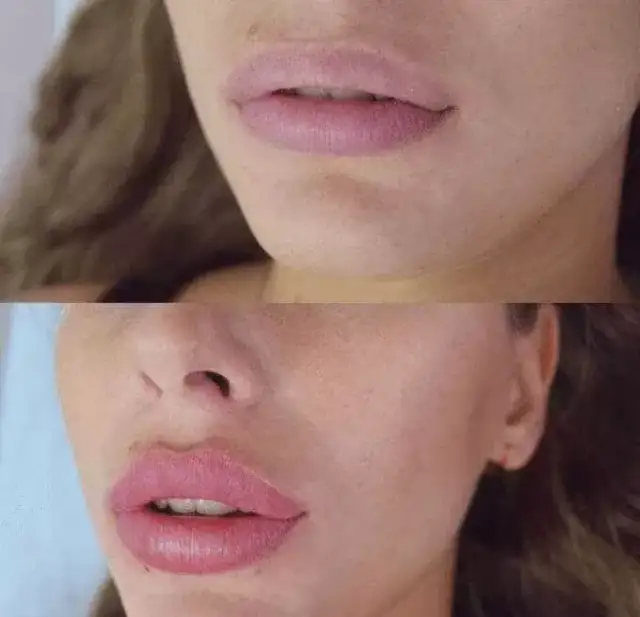 Ile to jest 1 ml kwasu hialuronowego i jak wpływa na efekty estetyczne