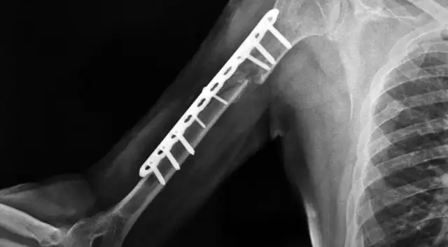 Złamanie kości: Kiedy start rehabilitacji? Nie trać czasu!