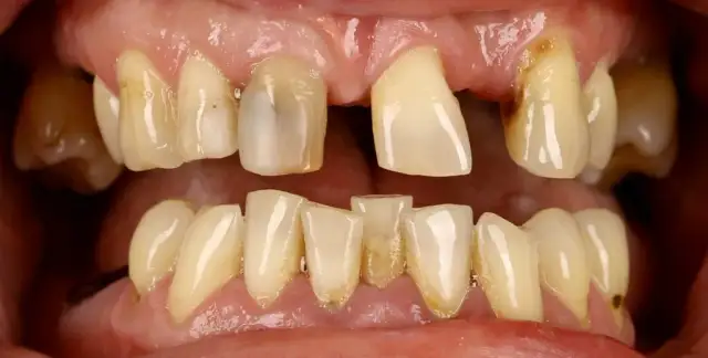 Most protetyczny: czy wygląda naturalnie? Zobacz zdjęcia i porady