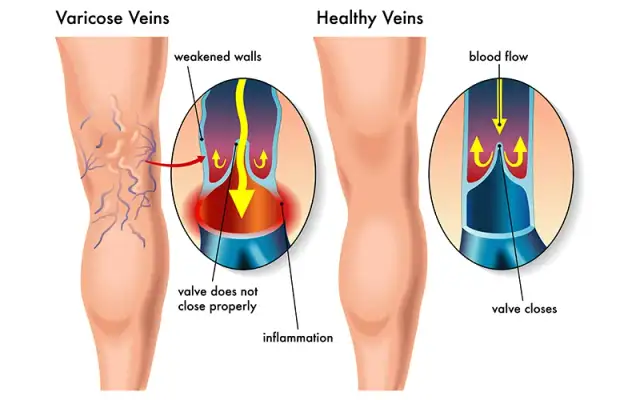 Bein Thrombose Symptome: Warnsignale erkennen & richtig handeln