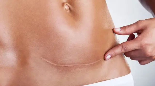 Fizjoterapia po cesarskim cięciu: Kiedy zacząć i jak wrócić do formy?