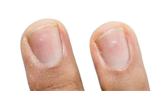 Dwa paznokcie, na jednym widoczne białe plamki, które mogą świadczyć o niedoborze minerałów.