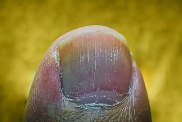 Jak skutecznie pozbyć się pionowych bruzd na paznokciach i poprawić ich wygląd