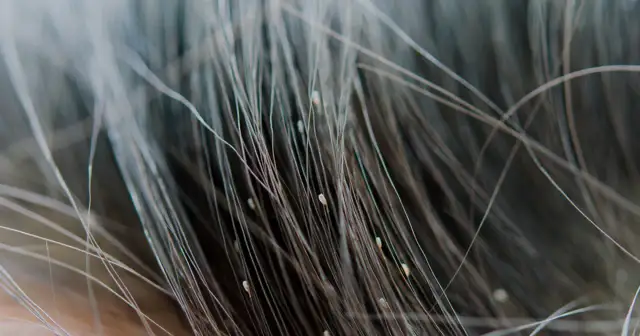 Wszawica u dziecka: Kiedy do szkoły? Już następnego dnia!