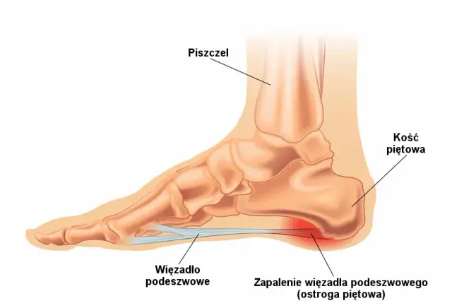 Jakie leki na ostrogę piętową skutecznie złagodzą ból?