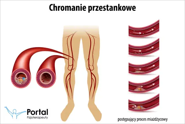 Chromanie przestankowe: Ćwiczenia, które cofną ból i przywrócą ruch