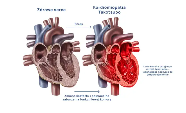 Objawy syndromu złamanego serca: Zawał czy takotsubo?