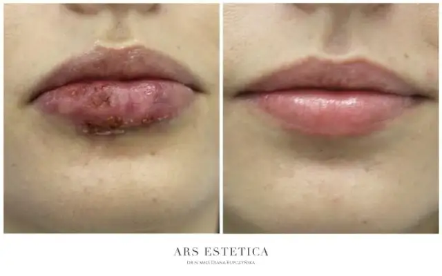 Martwica ust po kwasie: Kluczowe objawy i pilne kroki ratunkowe.