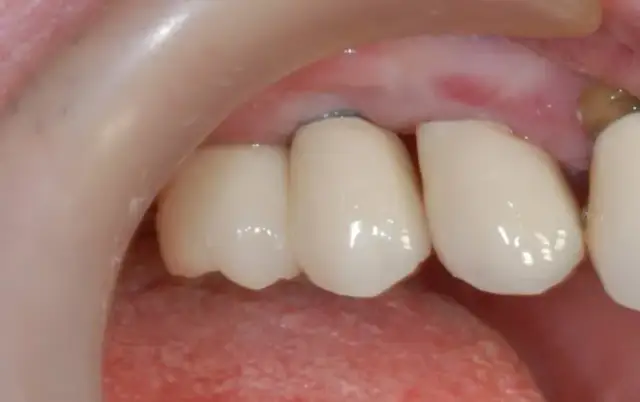 Skutki uboczne implantów z tytanu: jakie powikłania mogą cię zaskoczyć?