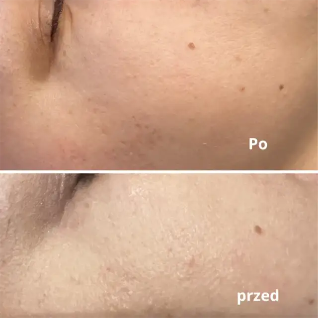 Kiedy makijaż po laserze frakcyjnym? Bezpieczne terminy i zasady