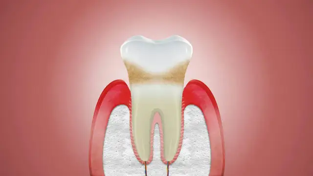 Uszkodzone dziąsła nie odrastają? Poznaj skuteczne metody leczenia