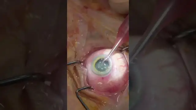 Jak wygląda zabieg usunięcia zaćmy? Wszystko, co musisz wiedzieć