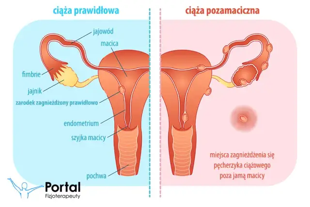 Objawy ciąży pozamacicznej: jak je rozpoznać i szybko reagować?