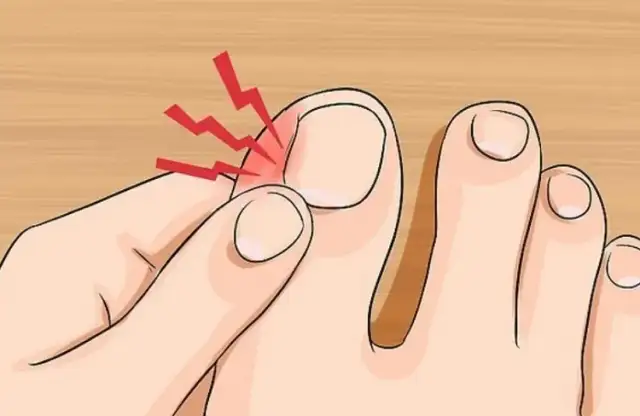 Jak pozbyć się wrastającego paznokcia: skuteczne metody i porady