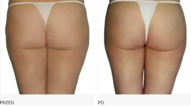 Endermologia co ile dni: Klucz do skutecznych efektów zabiegów