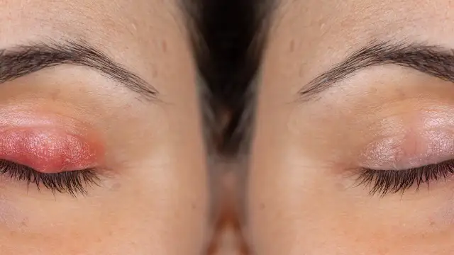 Choroby powiek: objawy i zdjęcia, które pomogą w identyfikacji