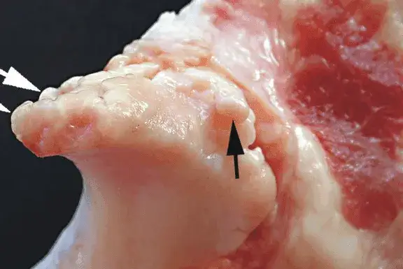 Osteofitoza: skuteczna rehabilitacja dla ulgi i lepszej sprawności