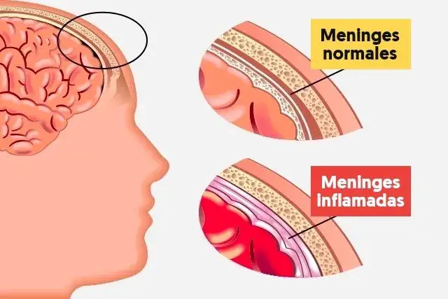 Síntomas de meningitis que no debes ignorar para tu salud