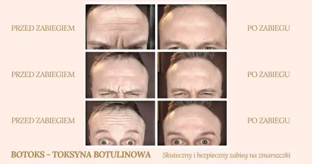 Jak długo utrzymuje się botoks na czoło? Poznaj kluczowe fakty