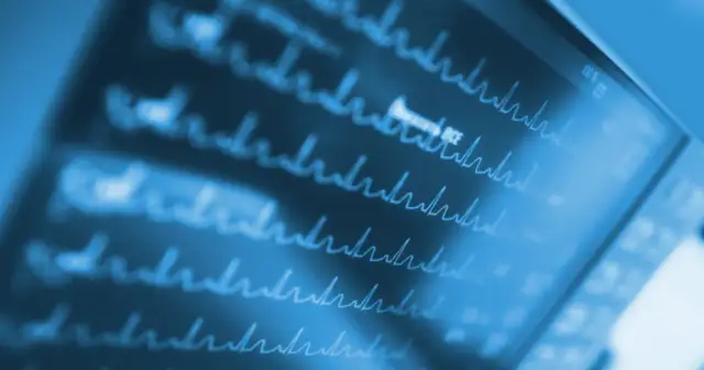 Migotanie przedsionków: Rozpoznaj objawy, uniknij udaru. Działaj!