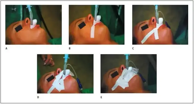 Intubacja ile może trwać? Poznaj czynniki wpływające na czas trwania