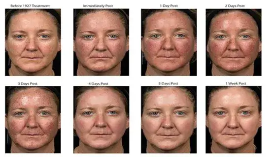 Jak pielęgnować twarz po laserze frakcyjnym, aby uniknąć komplikacji