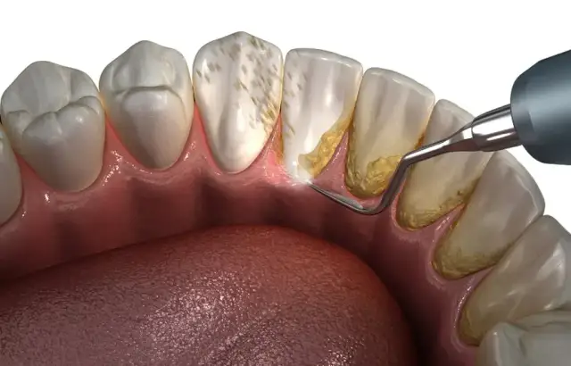 Ciążowe zapalenie dziąseł: Skuteczne i bezpieczne sposoby leczenia