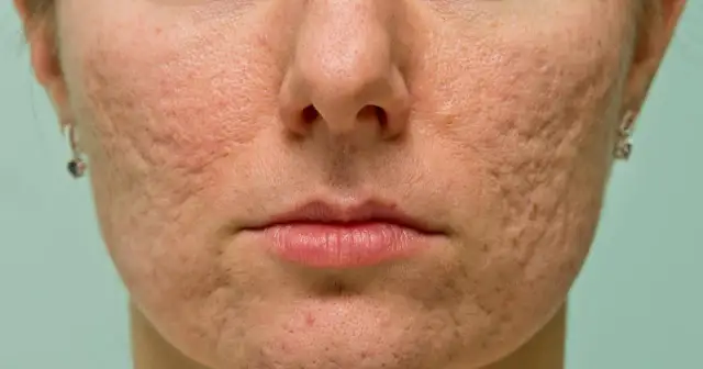 Pasta do zębów na pryszcze? Dermatolog radzi, co naprawdę działa!