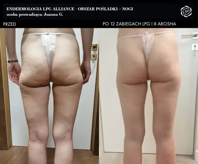 Endermologia: Ile cm stracisz w obwodzie? Mierzalne efekty!