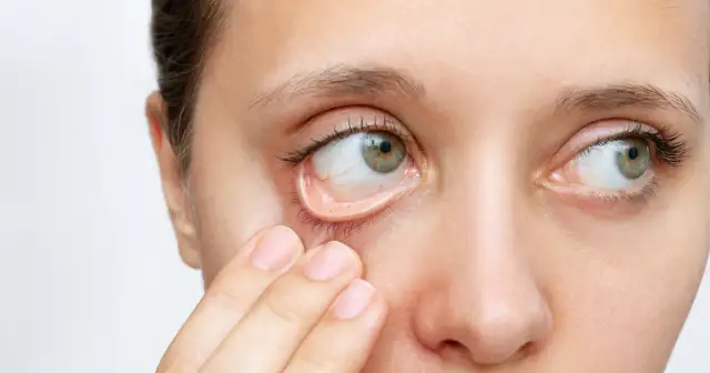 Niedobór żelaza: objawy, diagnoza i leczenie. Kiedy do lekarza?