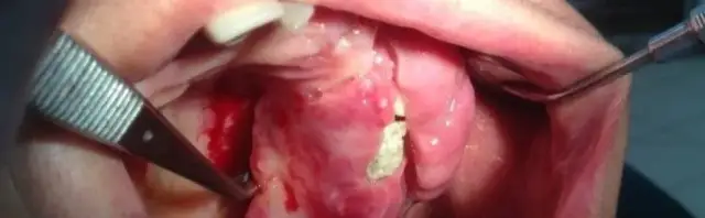 Włókniak jamy ustnej objawy: co musisz wiedzieć, aby uniknąć bólu