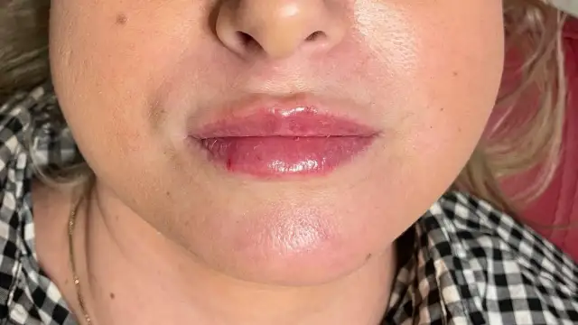 Jak wygląda martwica po kwasie hialuronowym i jak jej uniknąć?