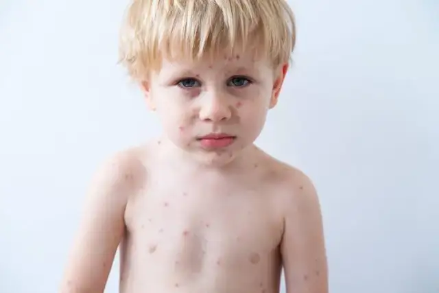 Jakie leki na bostonkę pomogą złagodzić objawy u dzieci?