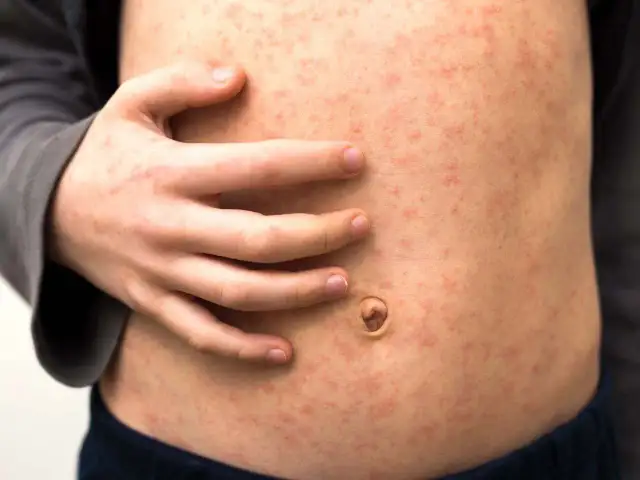 Dziecko z wysypką, objawem bostonki. Czerwone plamki pokrywają skórę brzucha, wywołując dyskomfort.